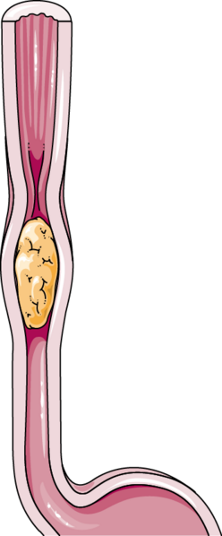 Contraction of muscles during peristalsis to move food through the digestive tract.Food getting contracted during peristalsis